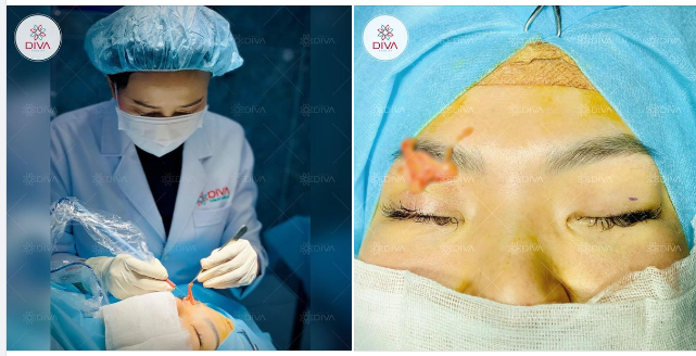 TẠM BIỆT MỠ THỪA MÍ MẮT CHỈ SAU 10 PHÚT!