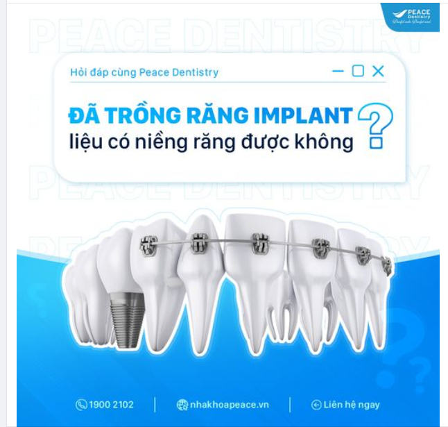 Tôi từng trồng răng Implant cách đây 3 năm nhưng bây giờ mới có ý định niềng răng cho đều đẹp hơn, liệu ĐÃ TRỒNG IMPLANT CÓ CÒN NIỀNG RĂNG ĐƯỢC KHÔNG thưa bác sĩ?