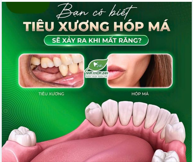 BẠN CÓ BIẾT TÌNH TRẠNG TIÊU XƯƠNG HÓP MÁ SẼ XẢY RA KHI MẤT RĂNG KHÔNG?