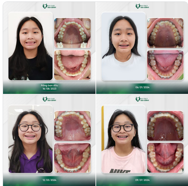 THAY ĐỔI RÕ RỆT TÌNH TRẠNG SAI LỆCH KHỚP CẮN VỚI NIỀNG RĂNG