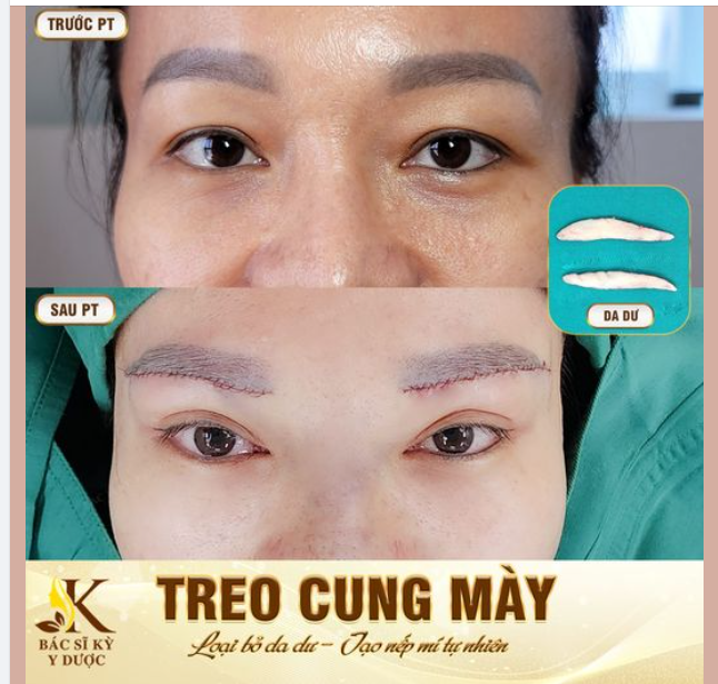 Treo Cung Mày - Loại Bỏ Da Dư, Mỡ Thừa