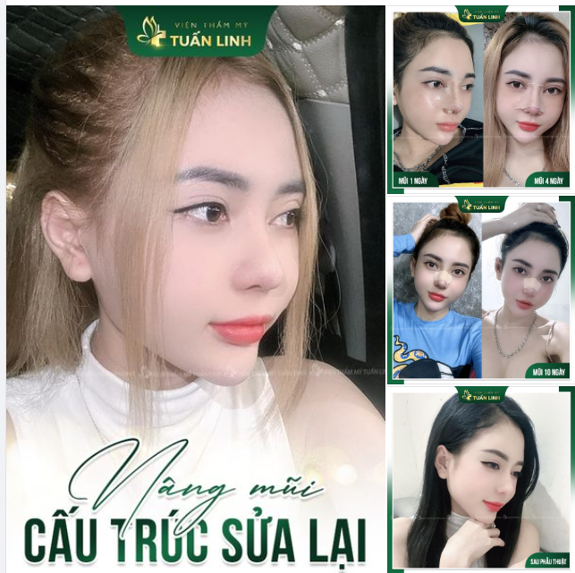 Cận cảnh dáng mũi sau 1 năm nâng cấu trúc sửa lại tại Tuấn Linh!!