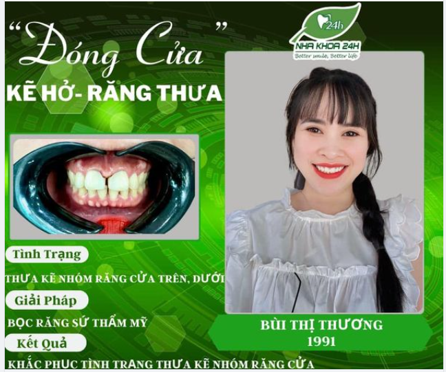 RĂNG THƯA HỞ KẼ - CƯỜI KHẼ CŨNG KHÔNG TỰ TIN