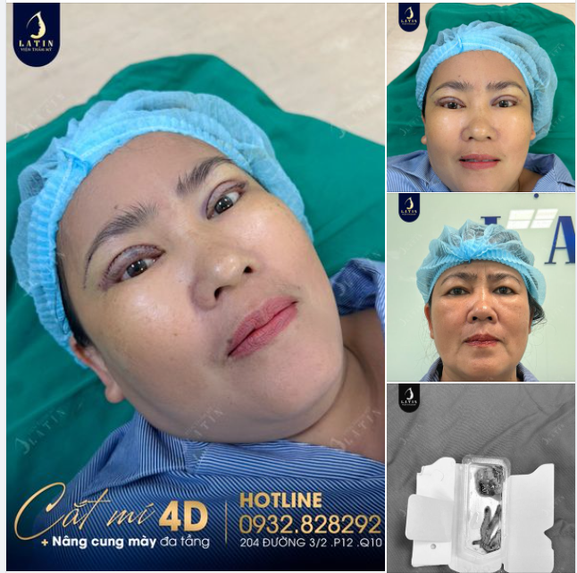 Combo Cắt mí 4D + Nâng cung mày đa tầng cho cô khách U60