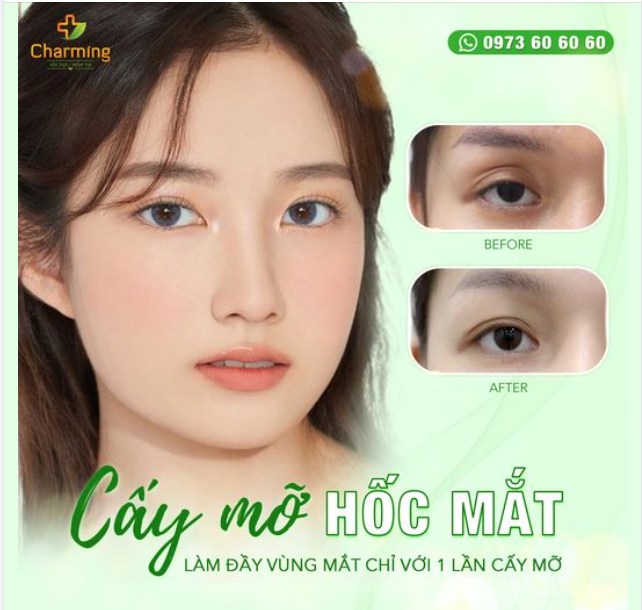 MẮT HỐC? ĐỪNG LO! CẤY MỠ LÀ XONG NGAY