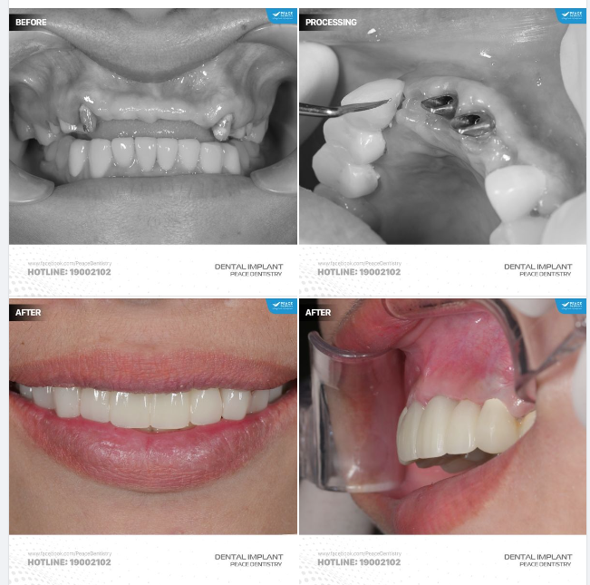 IMPLANT RĂNG CỬA