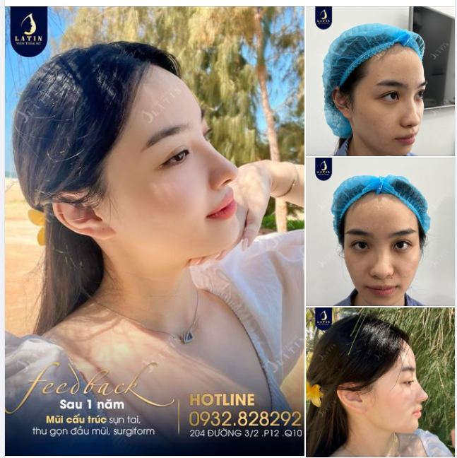 Sau 1 năm nâng mũi , em thay đổi như thế nào?