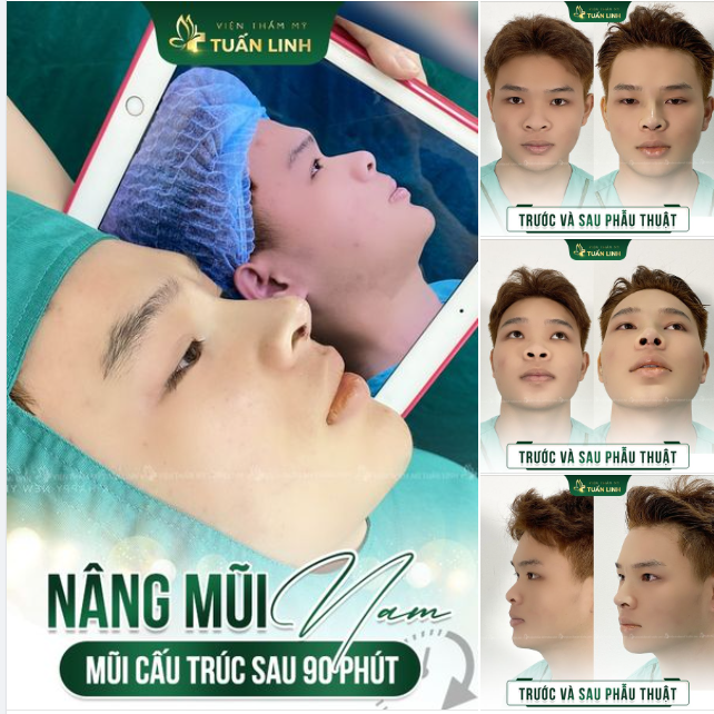 Chiêm ngưỡng kết quả nâng mũi sau 90 phút