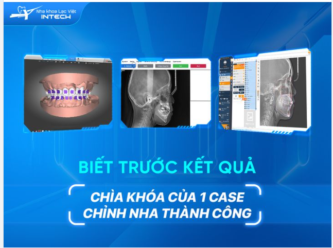 ĐƯỢC "SPOIL" 99,9% KẾT QUẢ NIỀNG RĂNG NHỜ CÔNG NGHỆ X-MATRIX