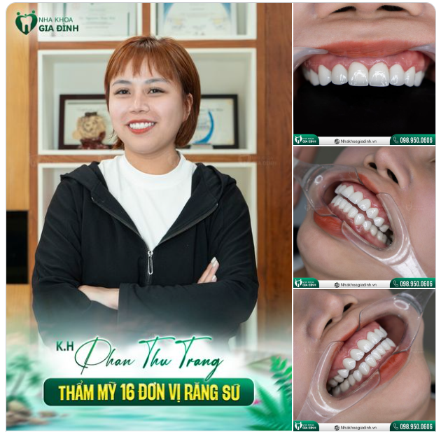 KHÔNG THỂ TIẾP TỤC VỚI HÀM RĂNG PHỦ SỨ NANO, CHỊ KHÁCH QUYẾT ĐỊNH THAY ĐỔI NỤ CƯỜI