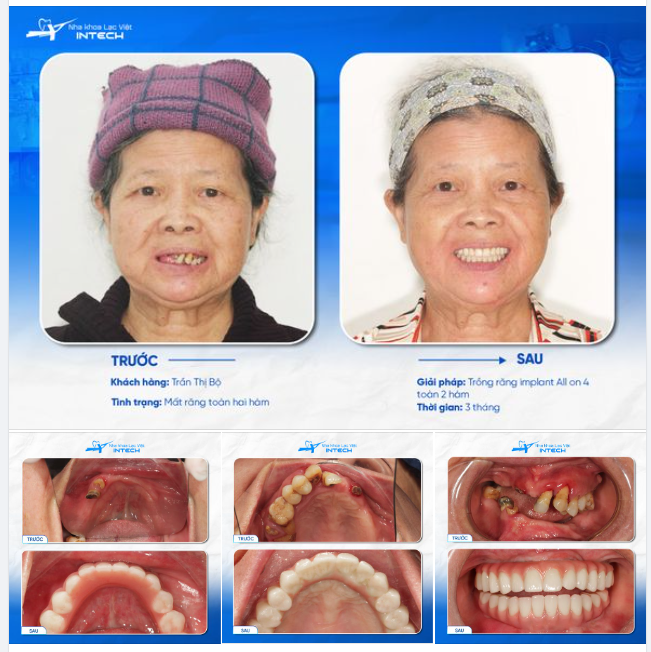 TUỔI GIÀ VIÊN MÃN KHI ĐƯỢC THAY RĂNG MỚI