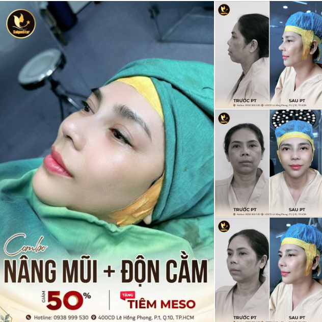 NÂNG MŨI + ĐỘN CẰM - KIẾN TẠO GƯƠNG MẶT CHUẨN TỈ LỆ