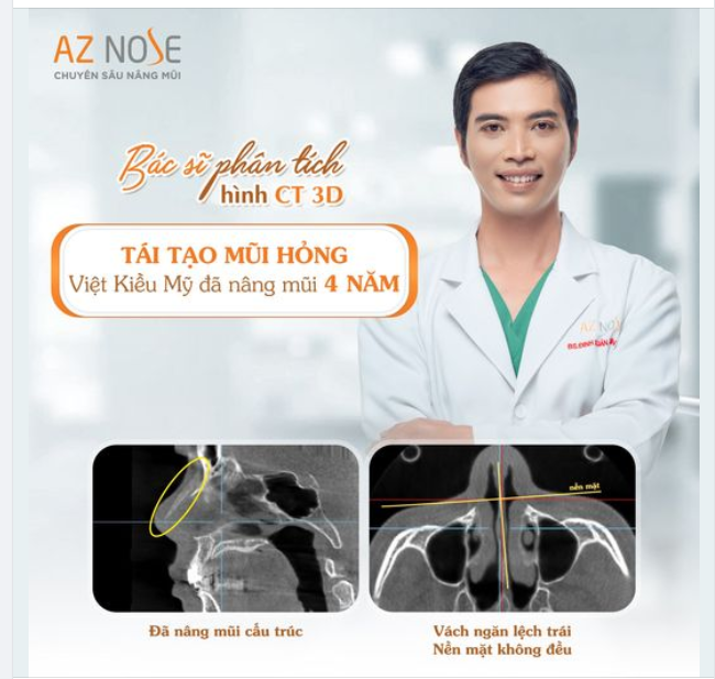 Khắc phục mũi cao thô - ngắn hếch cho khách hàng 9X