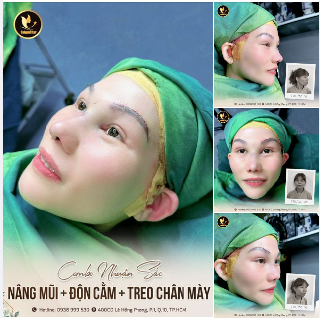 COMBO NHUẬN SẮC - THÀNH CÔNG GIÚP CHỊ KHÁCH ĐÀI LOAN XÓA BỎ MỌI KHOẢNG CÁCH VỀ NGOẠI HÌNH