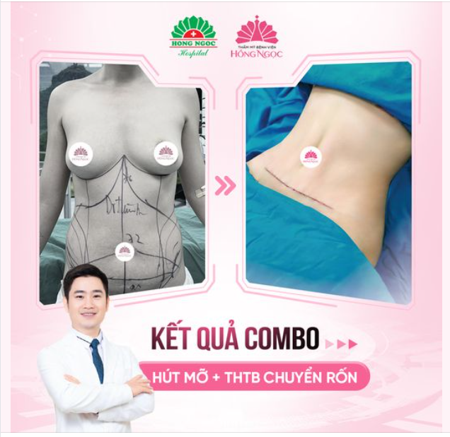 KẾT QUẢ ĐẸP MÊ CỦA CASE COMBO HUT MỠ + THTB CÓ CHUYỂN RỐN CỦA EKIP BS THÀNH