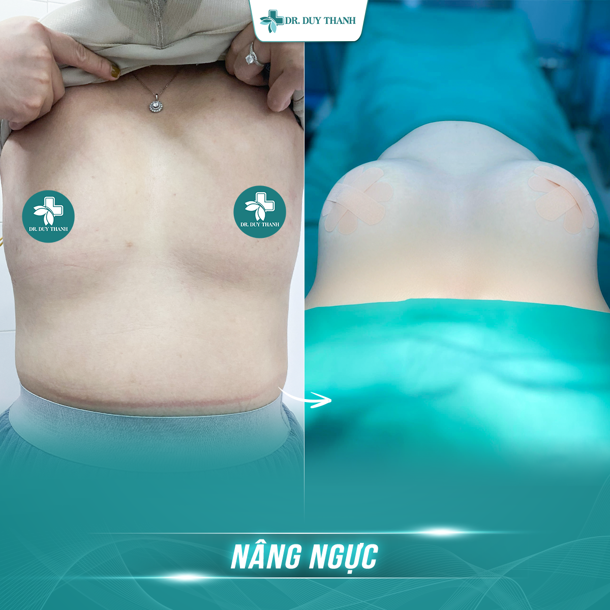 Nâng ngực cùng chị gái xinh như hotgirl cùng Dr Duy Thanh