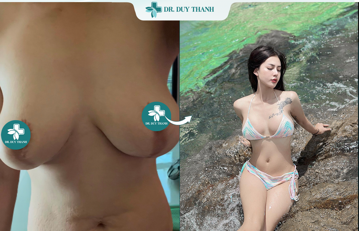 Ca nâng ngực hỏng được Dr Duy Thanh giải cứu