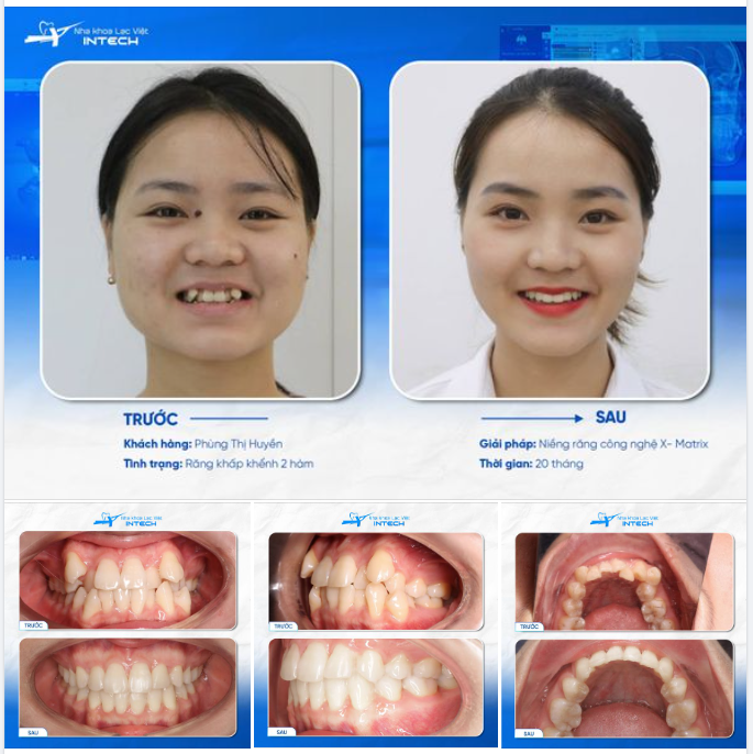 NIỀNG RĂNG MÀ NHƯ "THAY ĐẦU", NỮ KHÁCH HÀNG NHẬN CƠN MƯA LỜI KHEN VỀ NHAN SẮC!