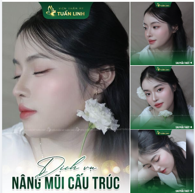 Nâng mũi cấu trúc - Chỉnh sửa mũi toàn diện Chưa bao giờ làm chị em thất vọng.