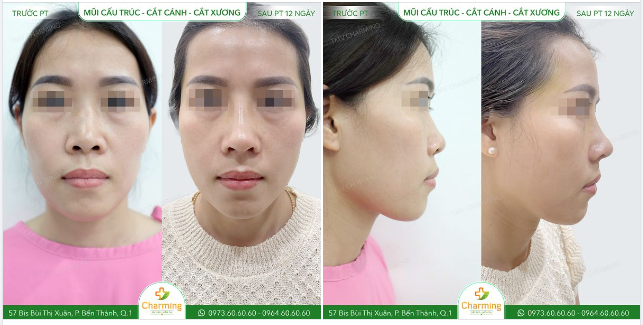 Mũi thấp không chỉ ảnh hưởng đến vẻ đẹp của khuôn mặt khi nhìn trực diện mà còn tạo một tỉ lệ không đẹp khi nhìn từ hai bên.