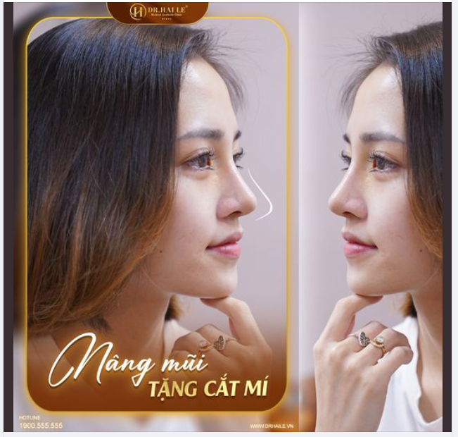 Nâng mũi FREE cắt mí