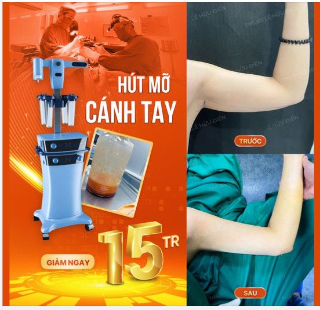 "Vì sao cứ đến hè là chị em lại rủ nhau đi HÚT MỠ CÁNH TAY vậy ạ ? "