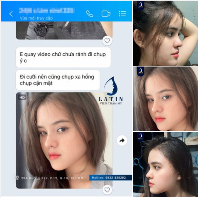 Feedback mũi cấu trúc sụn tai, sóng surgiform 1 tháng tuổi