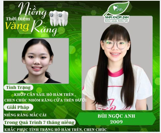Vẫn trong quá trình niềng nhưng răng bạn ấy đã thay đổi rất nhiều!