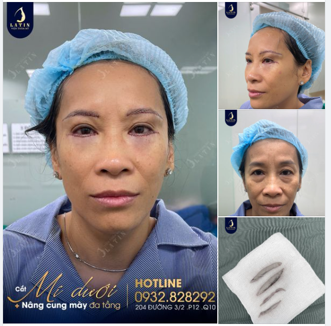 Nâng cung mày + Cắt mí dưới: Combo trẻ hóa cho khách hàng U60