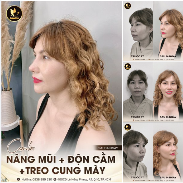 Chị Nguyễn T. Dương đến từ Đài Loan đã thành công thay đổi 360˚ chỉ sau 10 ngày về Việt Nam làm đẹp!!!