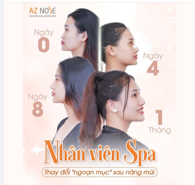 Nhân viên Spa: Gương mặt thay đổi 180 độ sau nâng mũi!