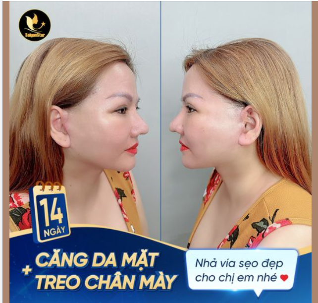 CĂNG DA MẶT + TREO CHÂN MÀY - XÓA TAN MỌI DẤU HIỆU LÃO HÓA