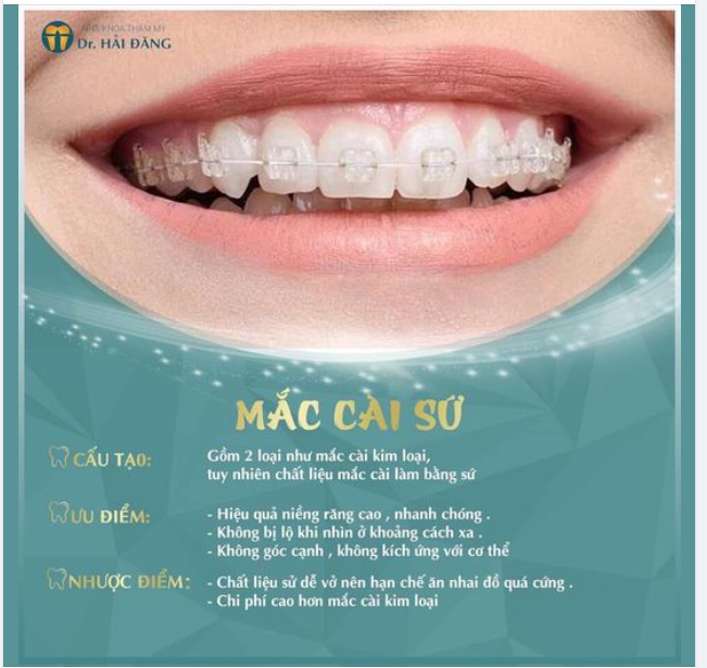 NIỀNG RĂNG MẮC CÀI SỨ: AN TOÀN  THẨM MĨ