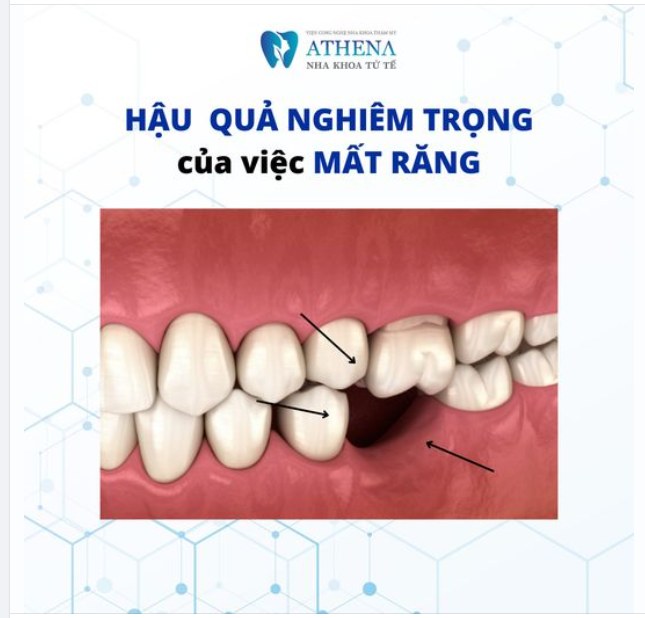 Hậu quả nghiêm trọng của mất răng mà ít người biết