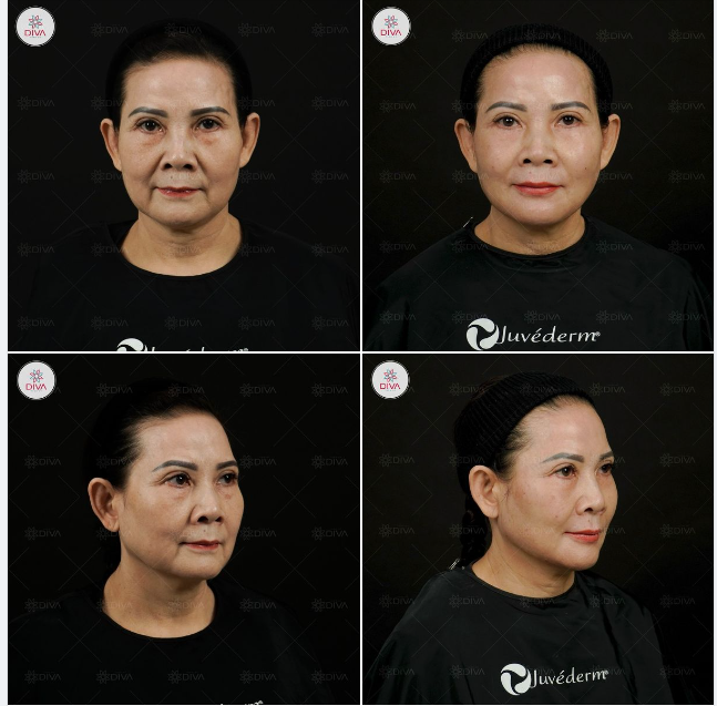 GƯƠNG MẶT THAY ĐỔI RA SAO SAU TIÊM 16CC FILLER MD CODES?