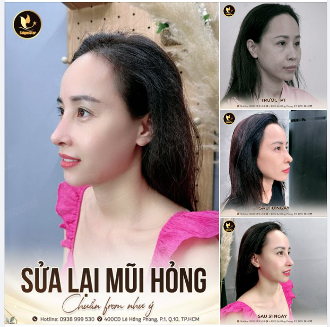 CHỊ EM NÀO ĐANG ĐAU ĐẦU VÌ DÁNG MŨI SAU NÂNG KHÔNG NHƯ Ý, BỊ BIẾN CHỨNG... THÌ VÀO ĐÂY XEM NGAY ĐI Ạ!