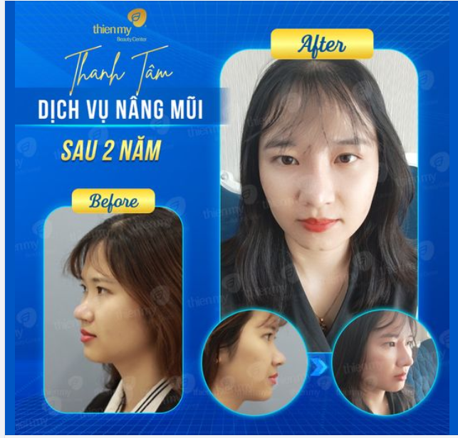 Chị Thanh Tâm nâng mũi sau 02 năm tại PKCK Thiện Mỹ