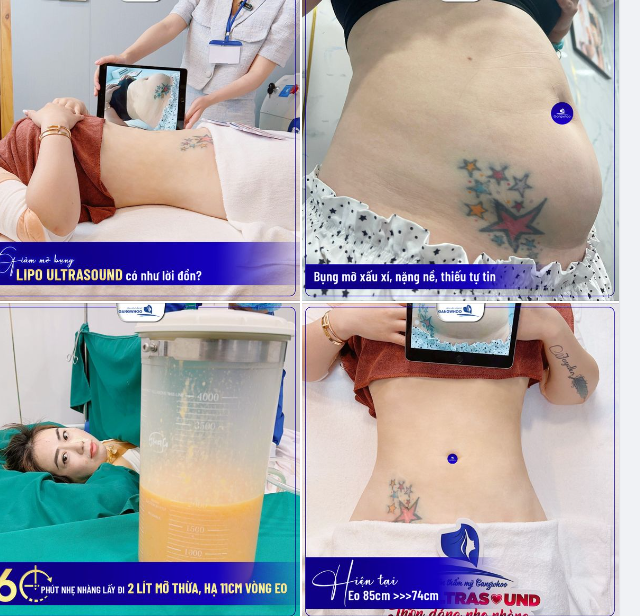 GIẢM MỠ BỤNG LIPO ULTRASOUND CÓ NHƯ LỜI ĐỒN?