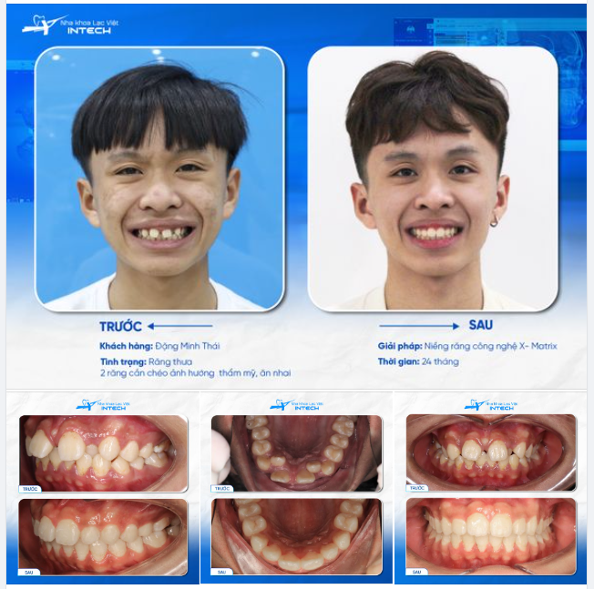 RĂNG THƯA THAY ĐỔI NỤ CƯỜI NGOẠN MỤC SAU THÁO MẮC CÀI