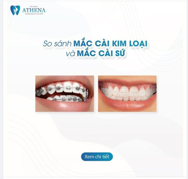 So sánh Niềng Răng Mắc Cài Kim Loại và Niềng Răng Mắc Cài Sứ: Bạn Chọn Phương Pháp Nào?