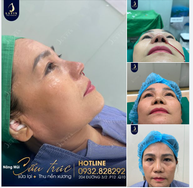Kết thúc ca sửa mũi với sự hài lòng của khách hàng là niềm hạnh phúc của bác sĩ và ekip tại Latin