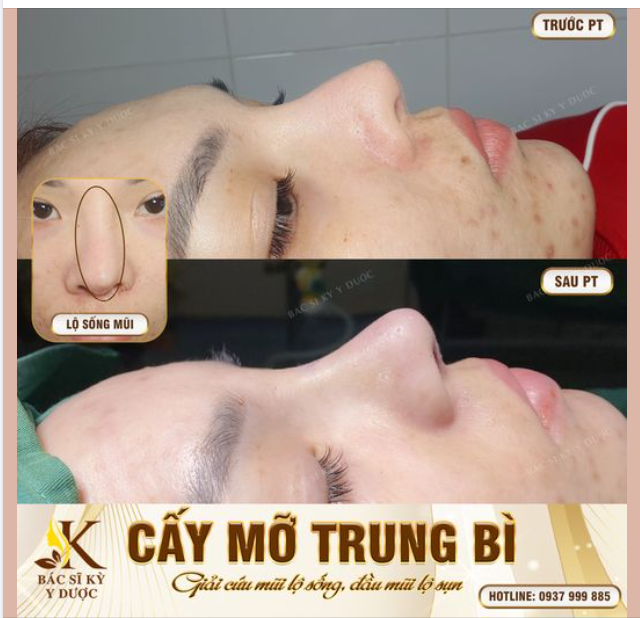 TRUNG BÌ MỠ - "CỨU TINH" CHO ĐẦU MŨI QUÁ MỎNG, MŨI BỊ TỔN THƯƠNG NHIỀU