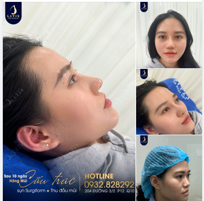 Em gái Đồng Nai tái khám mũi cấu trúc 10 ngày tuổi