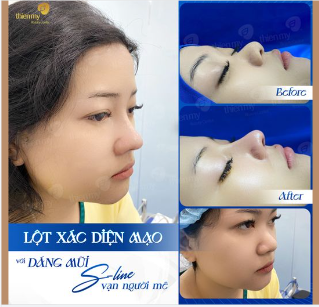 Lột xác diện mạo với dáng mũi sline vạn người mê