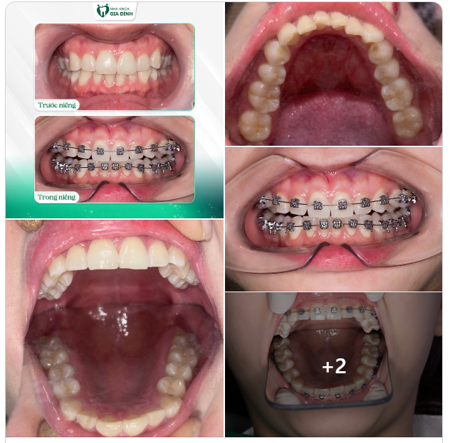 RĂNG ĐẸP RỒI, SAO PHẢI NIỀNG NỮA?