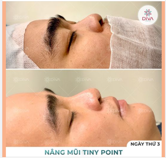 MŨI GÃY SÂU NGANG MẮT: PHƯƠNG PHÁP NÀO CẢI THIỆN TỐT NHẤT?