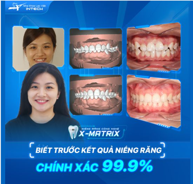 BIẾT TRƯỚC KẾT QUẢ CHÍNH XÁC - YẾU TỐ QUYẾT ĐỊNH THÀNH CÔNG CỦA CA NIỀNG RĂNG!