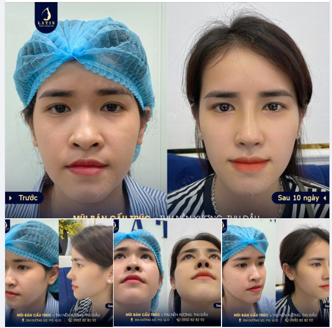 Mũi bán cấu trúc 10 ngày tuổi cho em gái