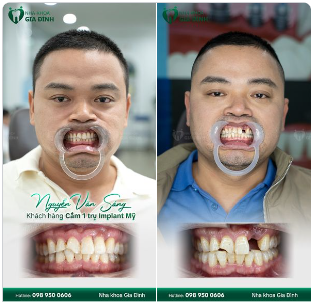 CẢI THIỆN TÌNH TRẠNG MẤT RĂNG CỬA VỚI TRỒNG RĂNG IMPLANT