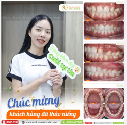 RĂNG ĐẸP NHƯ "ĐẬP ĐI XÂY LẠI" SAU NIỀNG